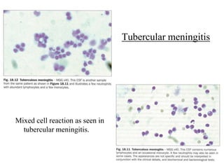 Tubercular meningitis
Mixed cell reaction as seen in
tubercular meningitis.
 