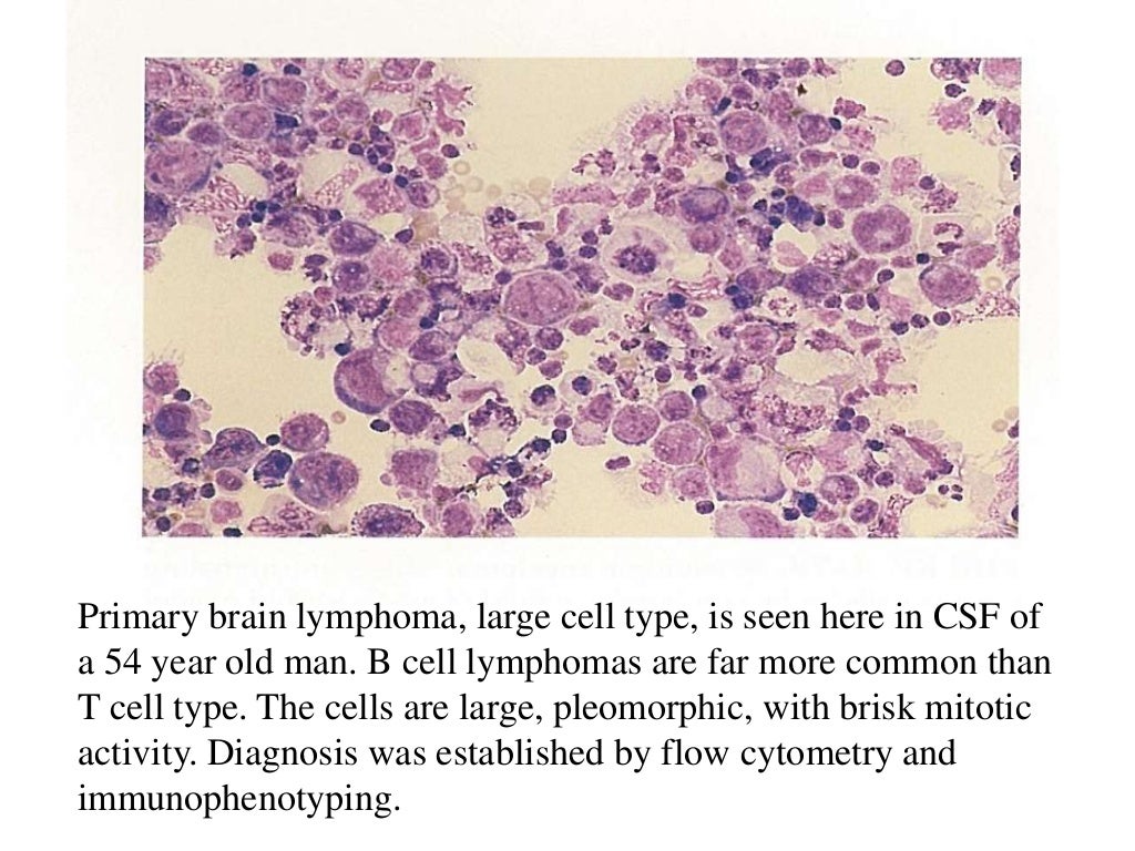 Fluid cytology in CSF