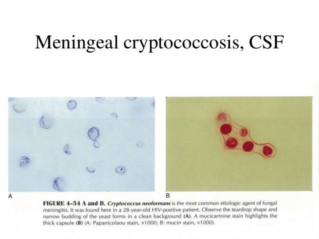 Fluid cytology in CSF