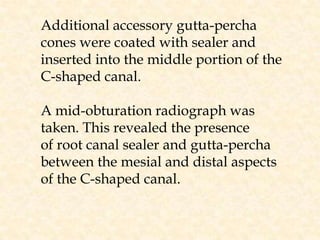 Additional accessory gutta-percha cones were coated with sealer and inserted into the middle portion of the C-shaped canal. A mid-obturation radiograph was taken. This revealed the presenceof root canal sealer and gutta-percha between the mesial and distal aspects of the C-shaped canal.