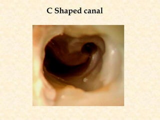 C Shaped canal