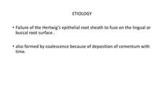 ETIOLOGY
• Failure of the Hertwig’s epithelial root sheath to fuse on the lingual or
buccal root surface .
• also formed by coalescence because of deposition of cementum with
time.
 