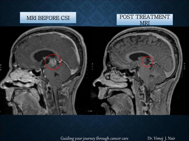 LOW DOSE CRANIOSPINAL IRRADIATION (CSI) USING VMAT , RADIATION FOR ...