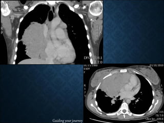 LOW DOSE CRANIOSPINAL IRRADIATION (CSI) USING VMAT , RADIATION FOR ...