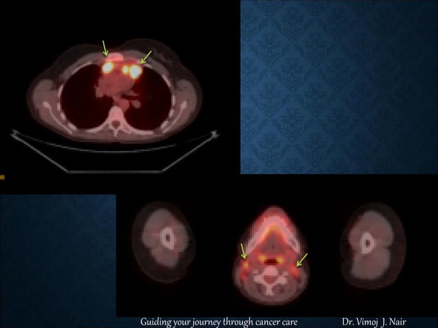 LOW DOSE CRANIOSPINAL IRRADIATION (CSI) USING VMAT , RADIATION FOR ...