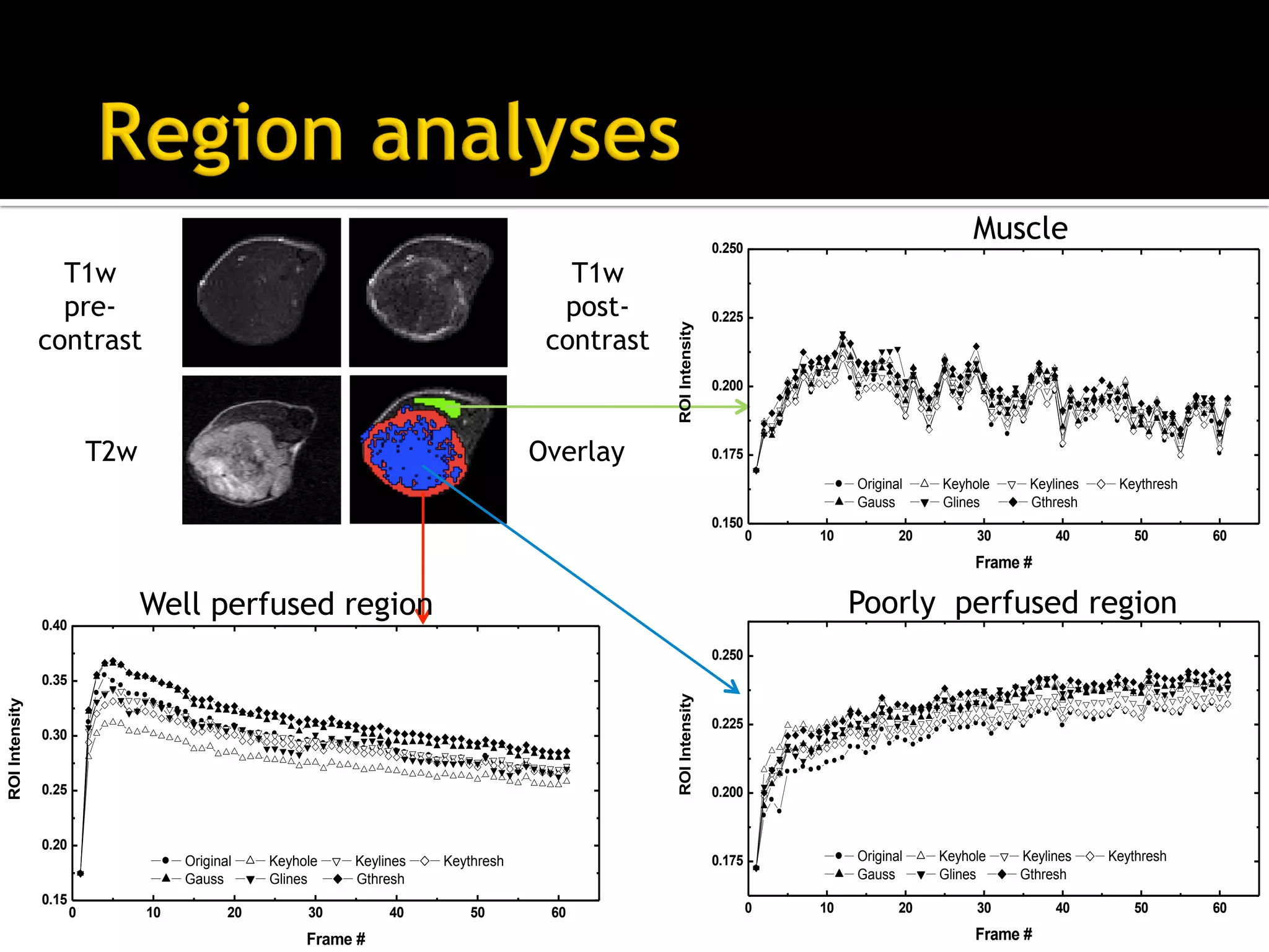 Introduction to compressed sensing MRI | PDF
