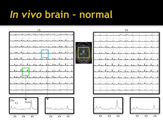 Introduction to compressed sensing MRI | PDF