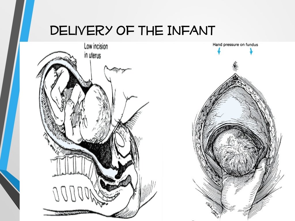 Cesarean Section CS