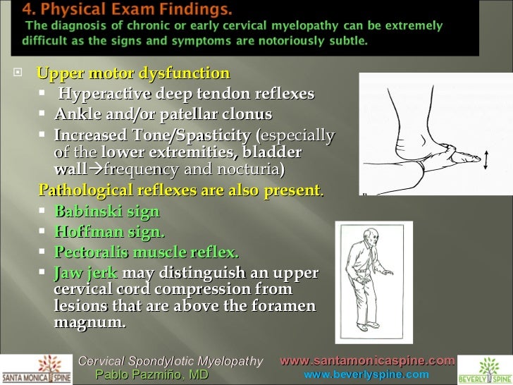 Cervical Arthritis Cervical Spondylotic Myelopathy By Pablo Pazmino