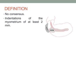 DEFINITION
• No consensus.
• Indentations of the
myometrium of at least 2
mm.