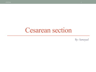 Cesarean section
By:- Sameyuel
4/20/2024 1
 