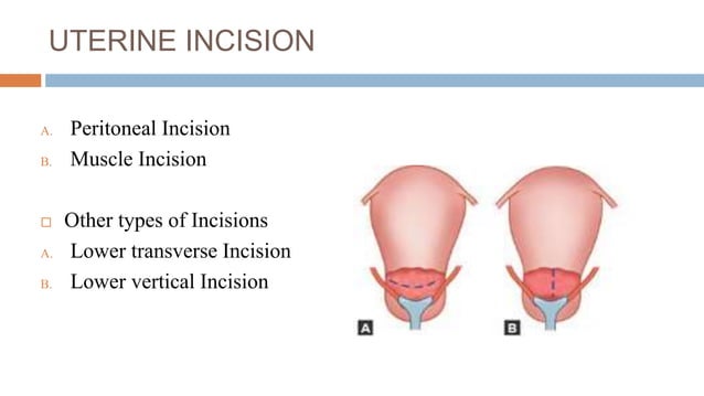 Lower segment cesarean section powe point presention | PPTX