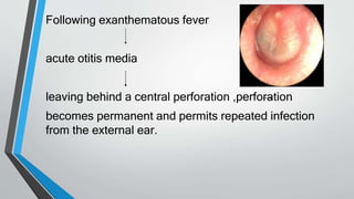 Following exanthematous fever
acute otitis media
leaving behind a central perforation ,perforation
becomes permanent and permits repeated infection
from the external ear.
 