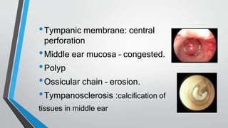 •Tympanic membrane: central
perforation
•Middle ear mucosa – congested.
•Polyp
•Ossicular chain – erosion.
•Tympanosclerosis :calcification of
tissues in middle ear
 