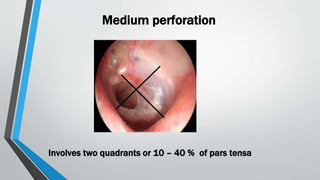 Medium perforation
Involves two quadrants or 10 – 40 % of pars tensa
 