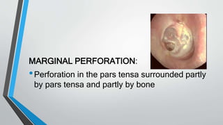 MARGINAL PERFORATION:
•Perforation in the pars tensa surrounded partly
by pars tensa and partly by bone
 