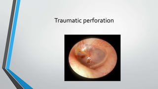 Traumatic perforation
 