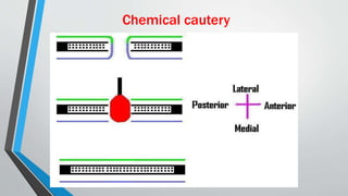 Chemical cautery
 