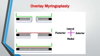 Overlay Myringoplasty
 