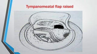 Tympanomeatal flap raised
 