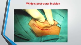 Wilde’s post-aural incision
 