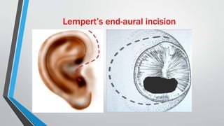 Lempert’s end-aural incision
 