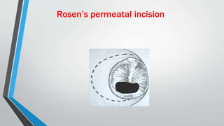 Rosen’s permeatal incision
 