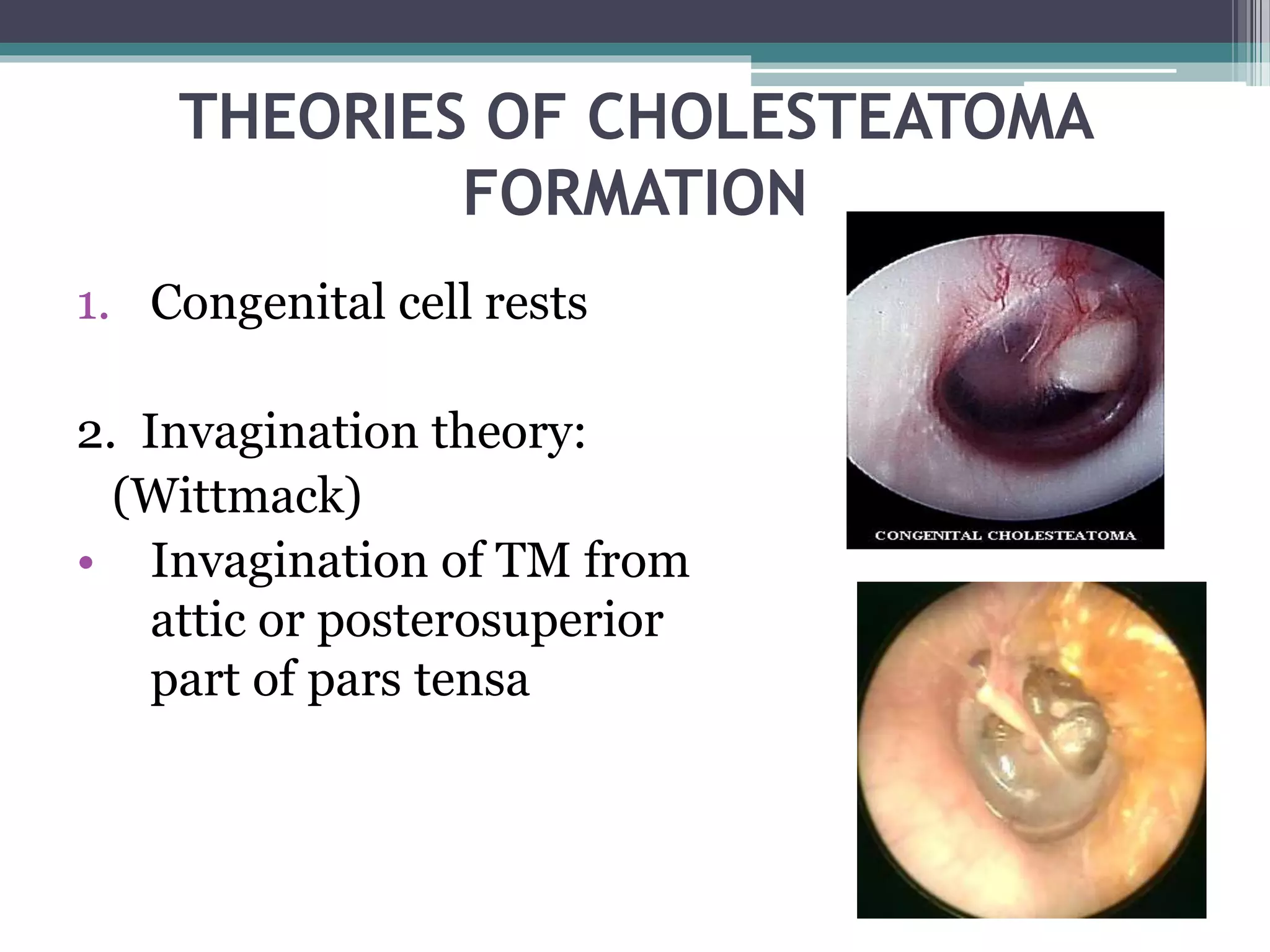 THEORIES OF CHOLESTEATOMA
FORMATION
1. Congenital cell rests
2. Invagination theory:
(Wittmack)
• Invagination of TM from
attic or posterosuperior
part of pars tensa
 