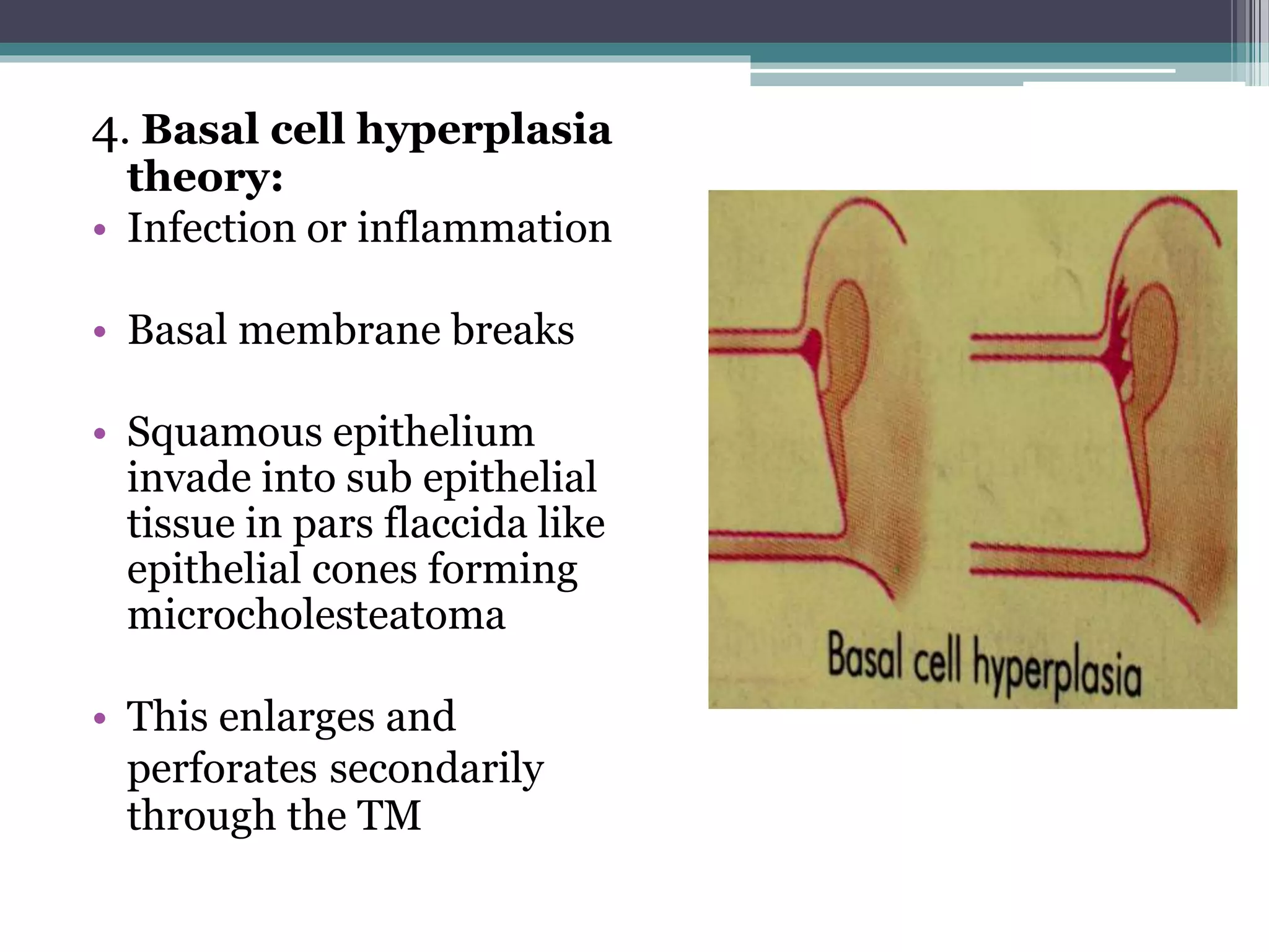 4. Basal cell hyperplasia
theory:
• Infection or inflammation
• Basal membrane breaks
• Squamous epithelium
invade into sub epithelial
tissue in pars flaccida like
epithelial cones forming
microcholesteatoma
• This enlarges and
perforates secondarily
through the TM
 