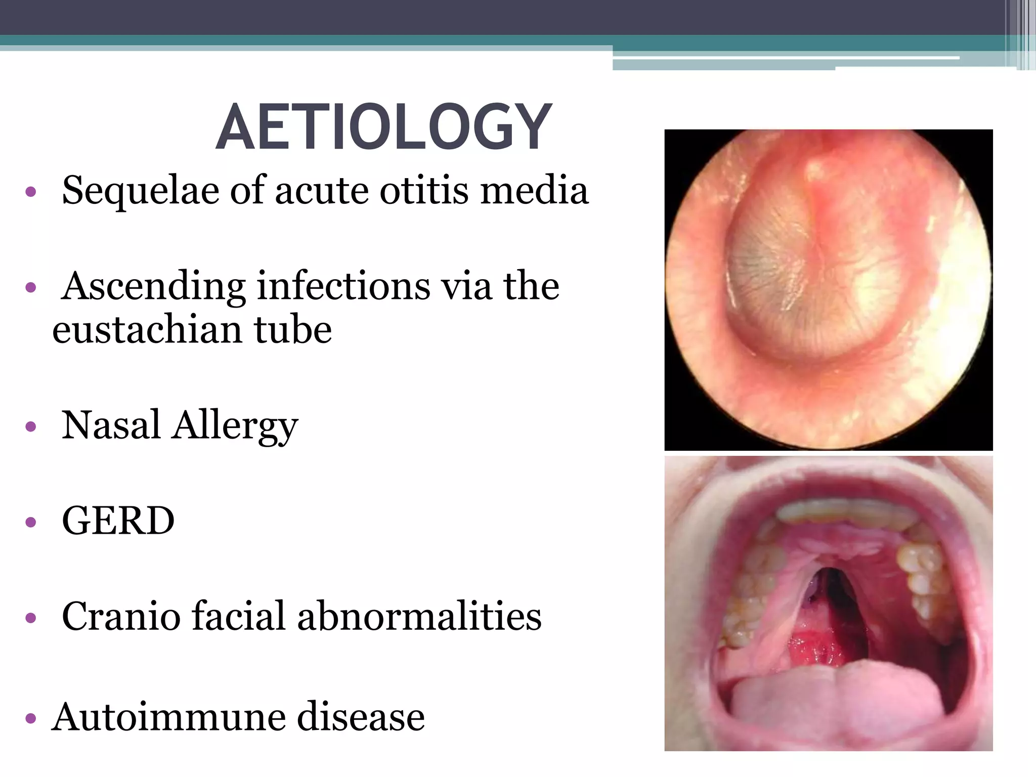 AETIOLOGY
• Sequelae of acute otitis media
• Ascending infections via the
eustachian tube
• Nasal Allergy
• GERD
• Cranio facial abnormalities
• Autoimmune disease
 