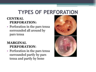 TYPES OF PERFORATION
CENTRAL
PERFORATION:
• Perforation in the pars tensa
sorrounded all around by
pars tensa
MARGINAL
PERFORATION:
• Perforation in the pars tensa
surrounded partly by pars
tensa and partly by bone
 