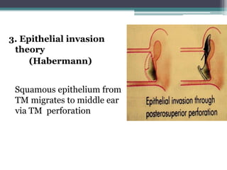 3. Epithelial invasion
theory
(Habermann)
Squamous epithelium from
TM migrates to middle ear
via TM perforation
 