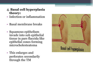 4. Basal cell hyperplasia
theory:
• Infection or inflammation
• Basal membrane breaks
• Squamous epithelium
invade into sub epithelial
tissue in pars flaccida like
epithelial cones forming
microcholesteatoma
• This enlarges and
perforates secondarily
through the TM
 