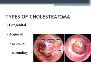 TYPES OF CHOLESTEATOMA
• Congenital
• Acquired
- primary
- secondary
 