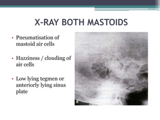 X-RAY BOTH MASTOIDS
• Pneumatisation of
mastoid air cells
• Hazziness / clouding of
air cells
• Low lying tegmen or
anteriorly lying sinus
plate
 