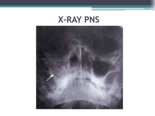 X-RAY PNS
 