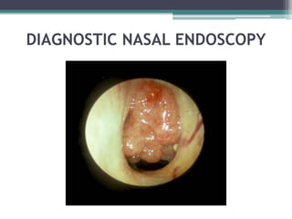 DIAGNOSTIC NASAL ENDOSCOPY
 