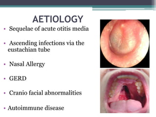 AETIOLOGY
• Sequelae of acute otitis media
• Ascending infections via the
eustachian tube
• Nasal Allergy
• GERD
• Cranio facial abnormalities
• Autoimmune disease
 