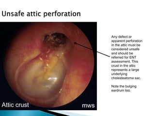 Csom a practical approach | PPTX | Ear, Nose and Throat Conditions ...
