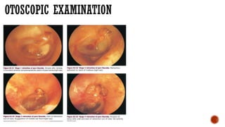chronic otitis media atticoantral disease .pptx