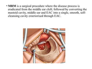 Comprehensive Overview of Chronic Otitis Media: Squamosal Disease and ...