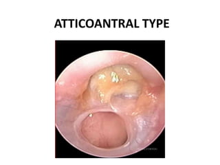 ATTICOANTRAL TYPE
 