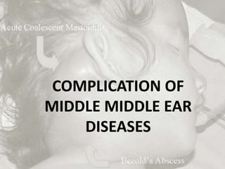 COMPLICATION OF
MIDDLE MIDDLE EAR
DISEASES
 