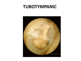 TUBOTYMPANIC
 