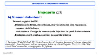 Claude EUGÈNE
CHOLANGITE SCLEROSANTE PRIMITIVE
Imagerie (2/5)


b) Scanner abdominal 1)


Peuvent suggérer la CSP:


. Dilatations modérées, discontinues, des voies biliaires intra-hépatiques,


souvent périphériques,


en l'absence d'image de masse après injection de produit de contraste


. Épaississement et réhaussement des parois biliaires


...........................................................................................................


1) Koshpouri P, Habibabadi RR, Hazhirbarzar B et al. Imaging features of primary slcerosing
cholangitis: from diagnosis to liver transplant follow up. RadioGraphics 2019;39:1938-1964.
(Accès libre sur internet, iconographie: 30 figures).
13
 