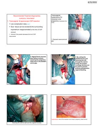 8/25/2022
Recommended Treatment Approaches
SURGICAL TREATMENT
1. Transvaginal & laparoscopic CSP resection
 Low complication rates.39e41
 Scar tissue can be excised & the surrounding
myometrium reapproximated at the time of CSP
removal.
 Unknown if this practice decreases the risk of CSP
reoccurrence.
Transvaginal
hysterotomy for
cesarean scar
pregnancy (Huanxiao et al,
2015)
1. Exposed vesicocervical
gap.
2. Vaginal fornix mucosa
seen before incision,
exposing the pregnancy
mass scar in the bladder-
cervix gap.
3. By cutting the
gestational sac and
removing the villi
through the uterine
cavity, the suction
curettage decidua can
be used to prevent
profuse postoperative
vaginal bleeding.
Suturing the uterine wall and the vaginal mucosa.
Laparoscopic view of the cesarean scar ectopic pregnancy (black arrow).
 