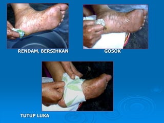RENDAM, BERSIHKAN GOSOK 
TUTUP LUKA 
 