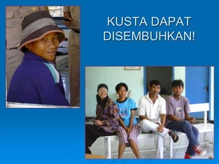 KUSTA DAPAT 
DISEMBUHKAN! 
 