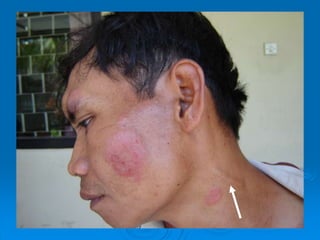 Melawan kusta