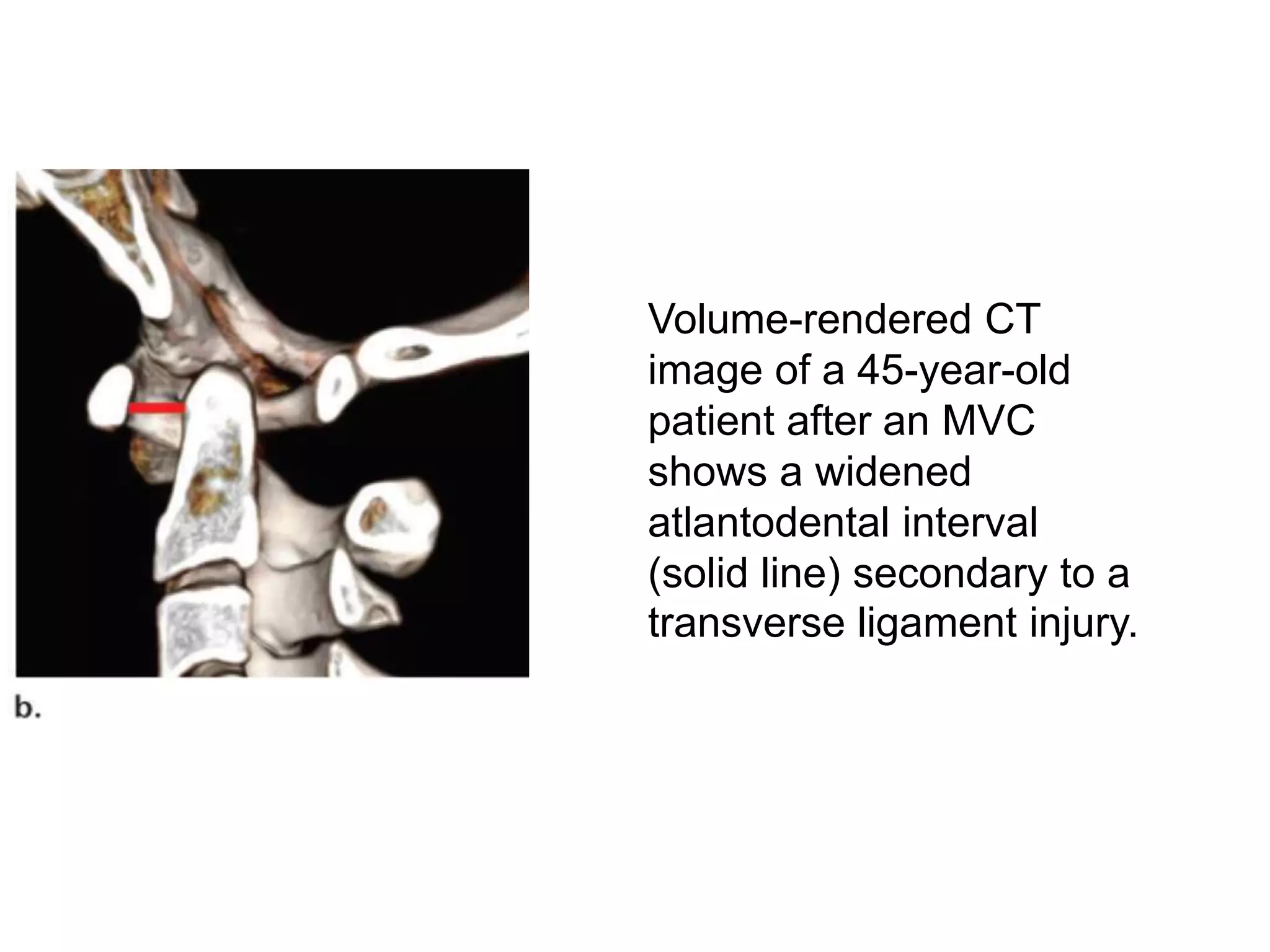 CT Cervical Spine | PPTX